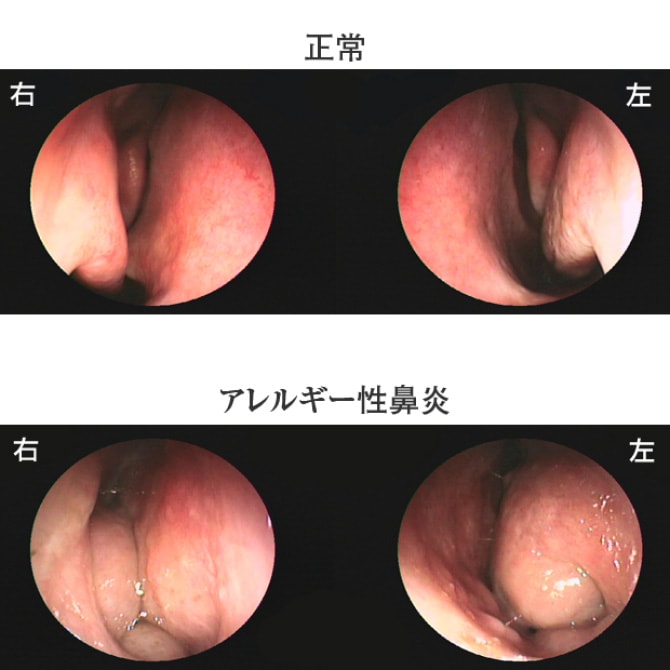 正常時とアレルギー性鼻炎時の鼻の中の様子