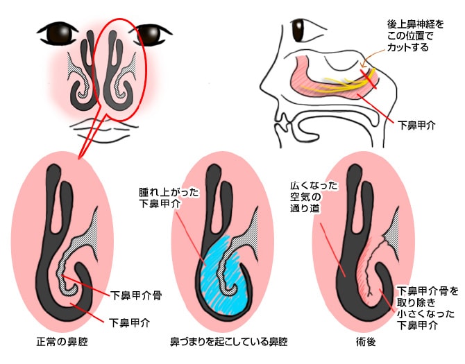 翼突管神経切除術（経鼻法）を解説したイラスト