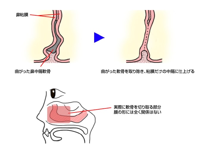 鼻中隔矯正術を解説したイラスト