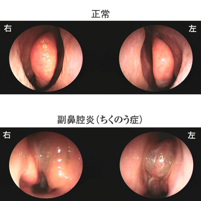 正常時と副鼻腔炎（ちくのう症）の鼻の中の様子