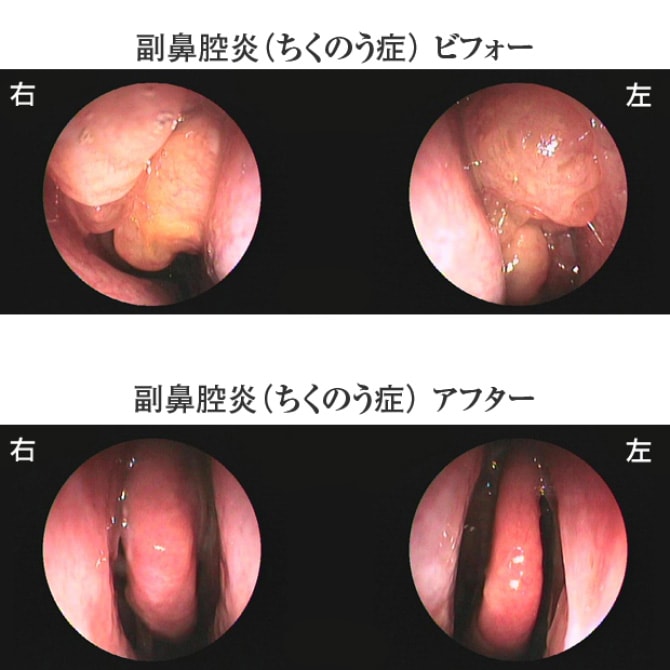 副鼻腔炎（ちくのう症）ビフォーアフターの鼻の中の様子