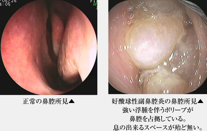 「正常の鼻腔所見」と「好酸球性副鼻腔炎の鼻腔所見」