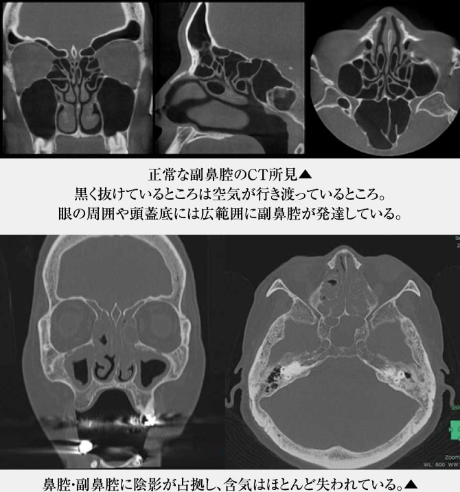 「正常な副鼻腔のCT所見」と「鼻腔・副鼻腔に陰影が占拠し、含気はほとんど失われている様子」