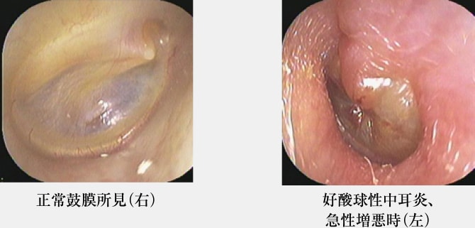 「正常鼓膜所見（右）」と「好酸球性中耳炎、急性増悪時（左）」