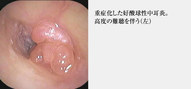 重症化した好酸球性中耳炎。高度の難聴を伴う（左）