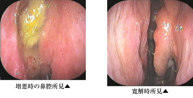 「増悪時の鼻腔所見」と「寛解時所見」